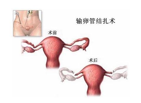 泰国试管婴儿