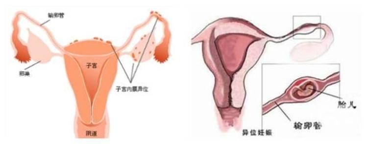 代孕试管婴儿